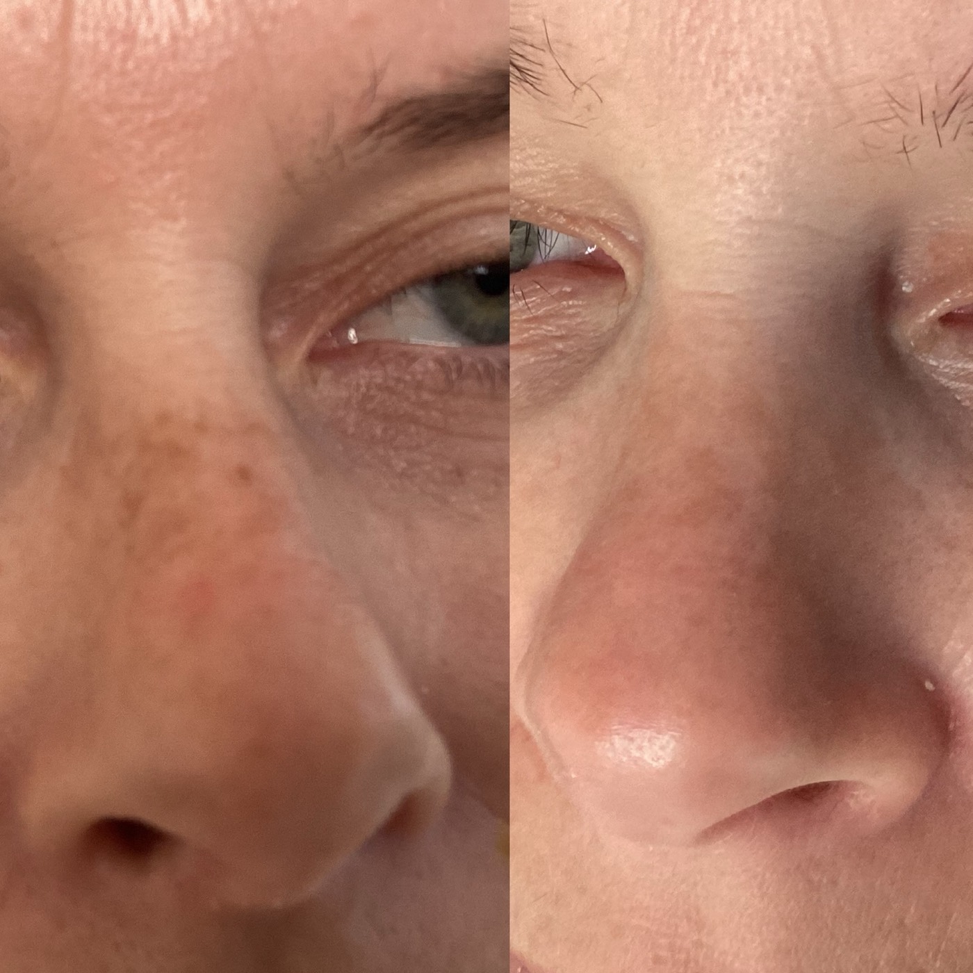 IPL Skin Pigmentation before and after result 1