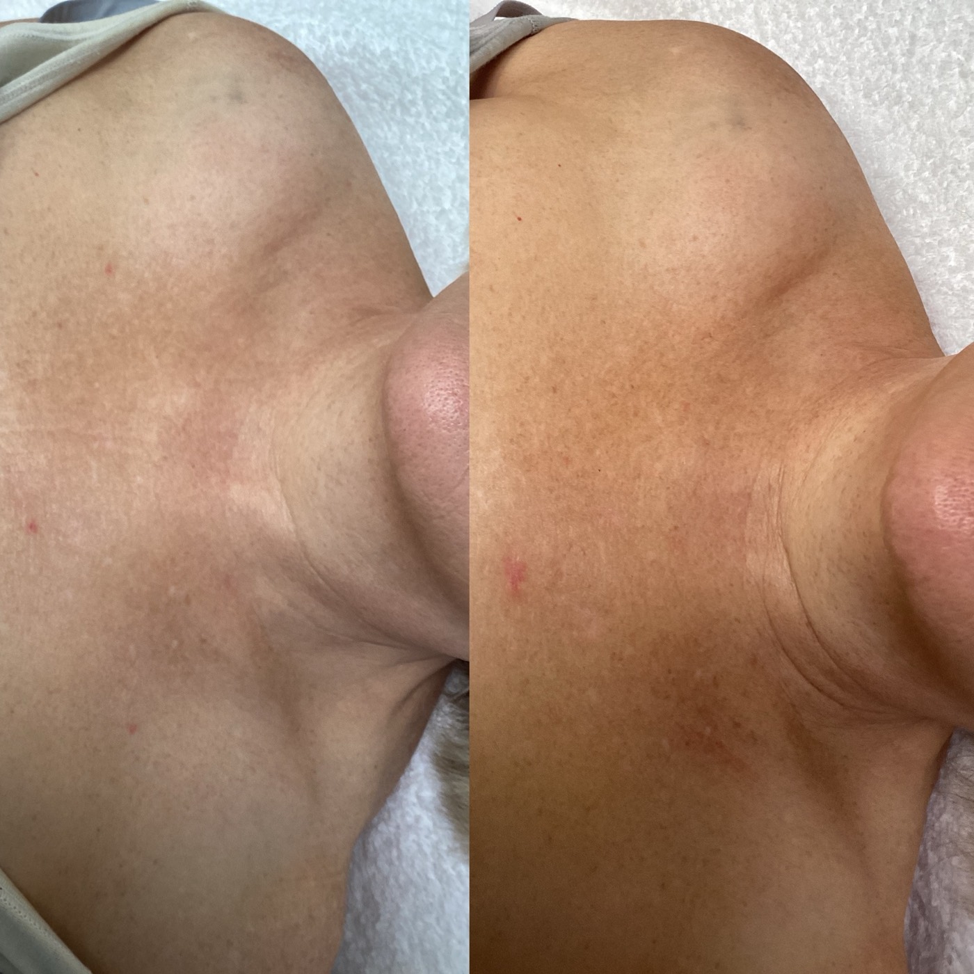 IPL Skin Pigmentation before and after result 2