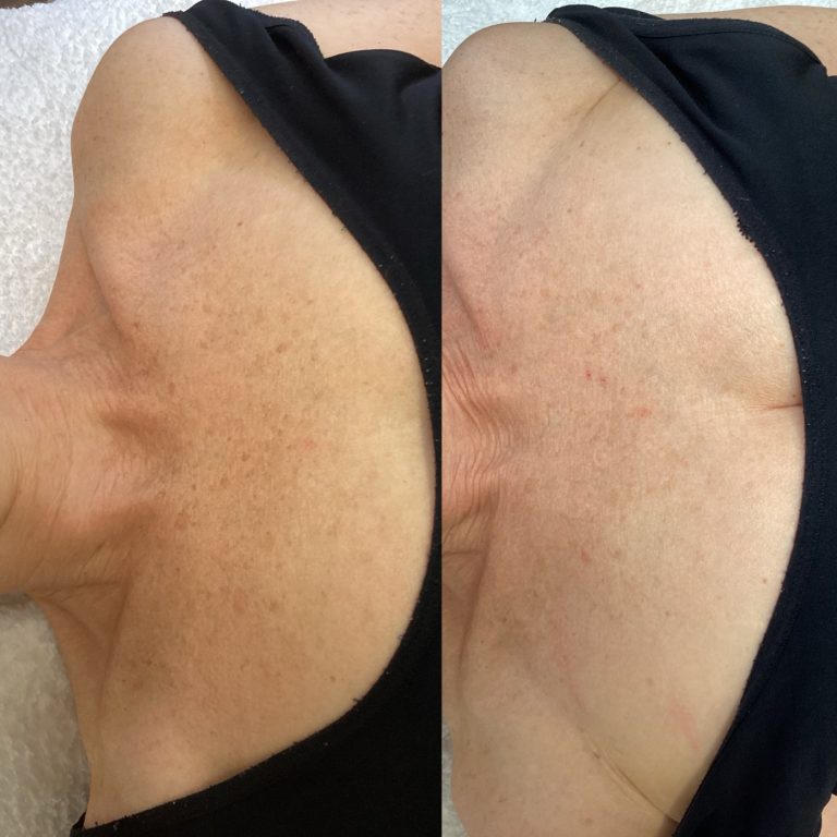 IPL Skin Pigmentation before and after result 3