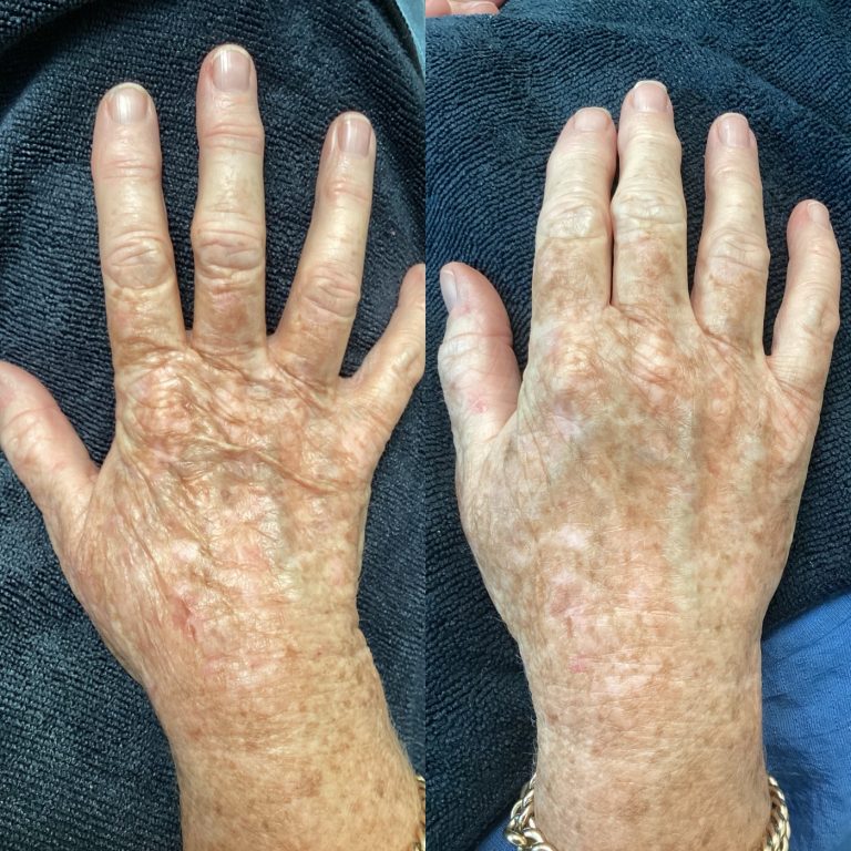 IPL Skin Pigmentation before and after result 4