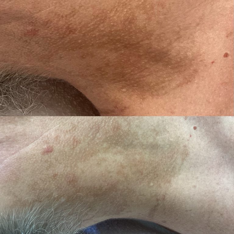 IPL Skin Pigmentation before and after result 5
