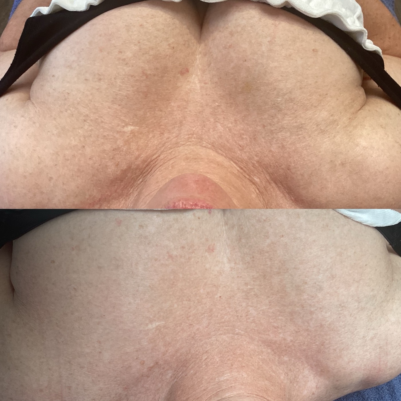 IPL Skin Pigmentation before and after result 6