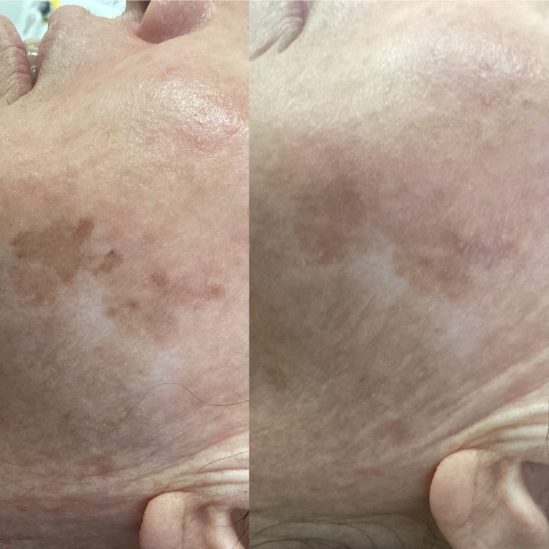 IPL Skin Pigmentation before and after result 7