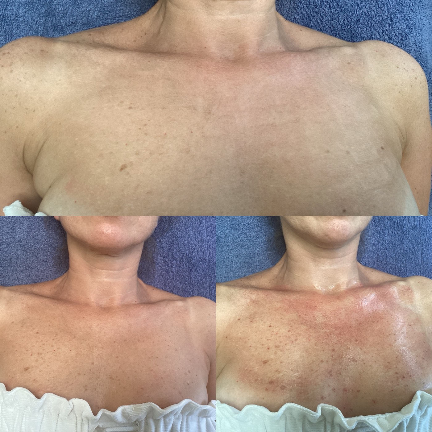 IPL Skin Pigmentation before and after result 8