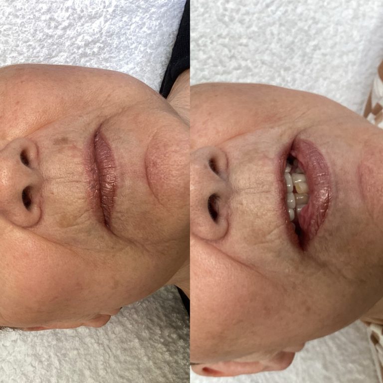 IPL Skin Pigmentation before and after result 9