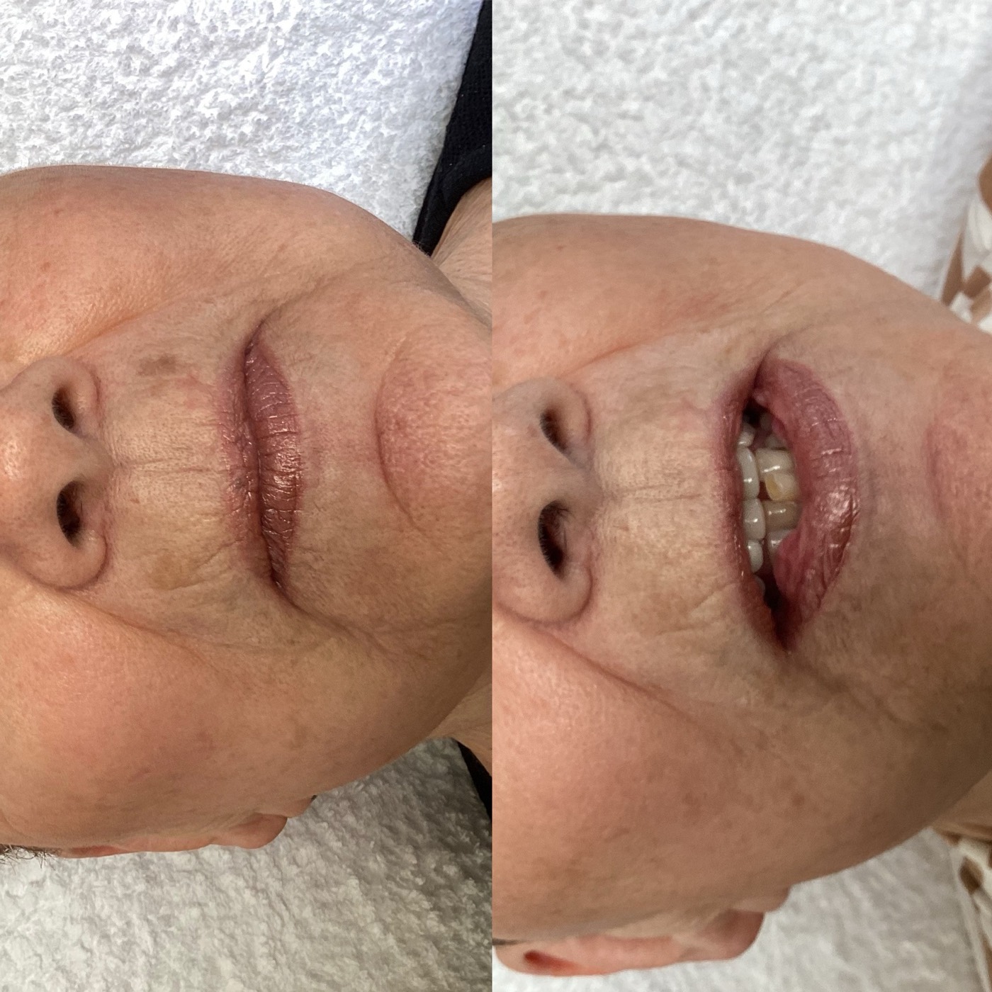IPL Skin Pigmentation before and after result 9