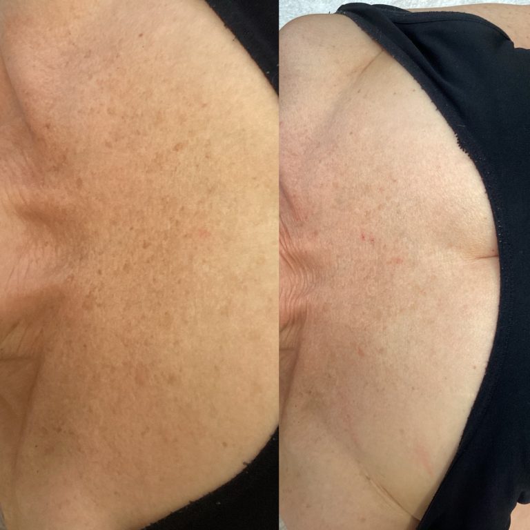 IPL Skin Pigmentation before and after result 10