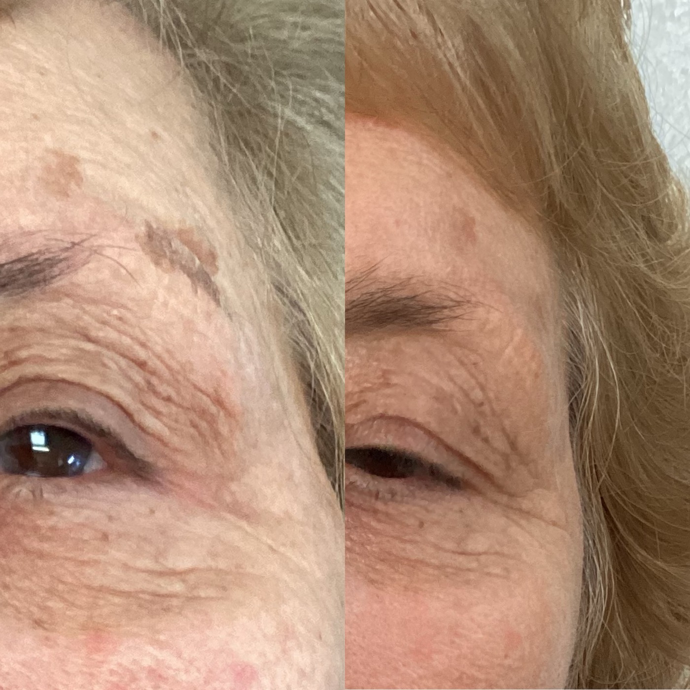 IPL Skin Pigmentation before and after result 11