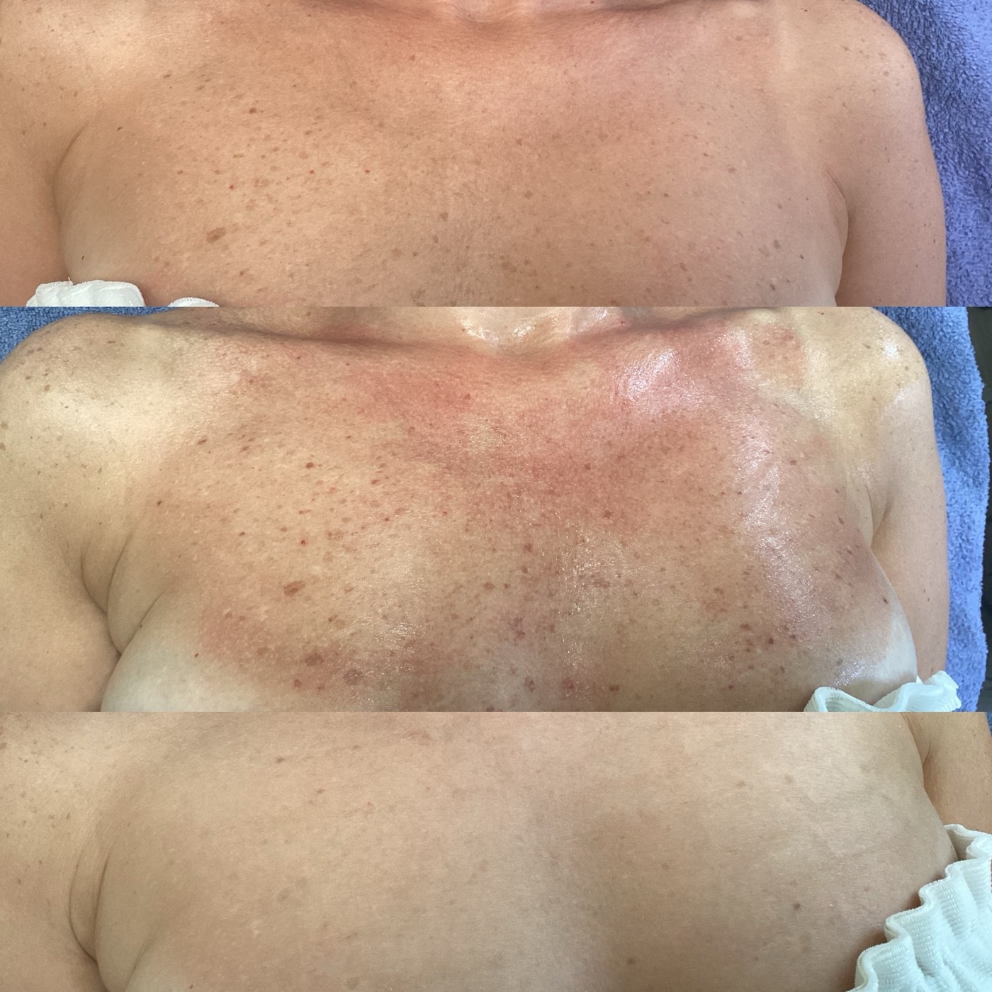 IPL Skin Pigmentation before and after result 12
