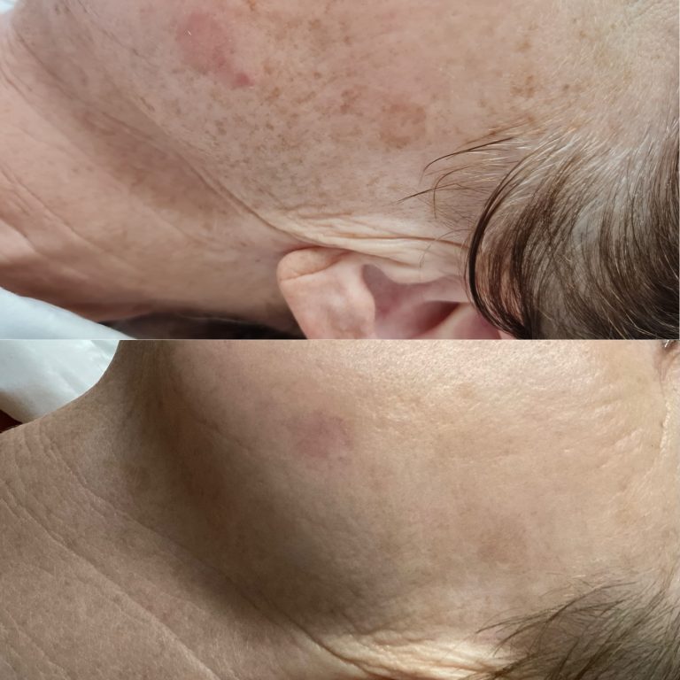 IPL Skin Pigmentation before and after result 13