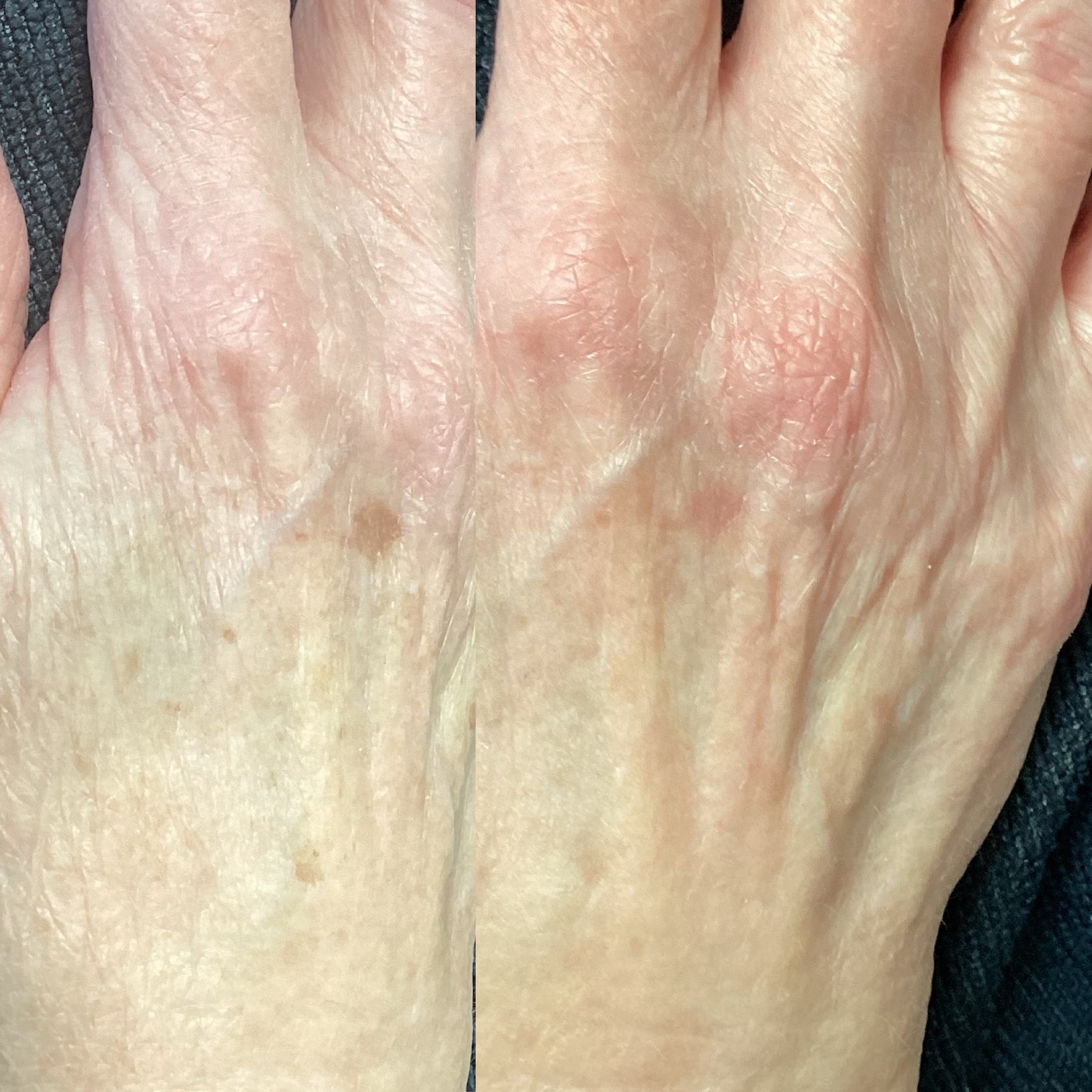 IPL Skin Pigmentation before and after result 14