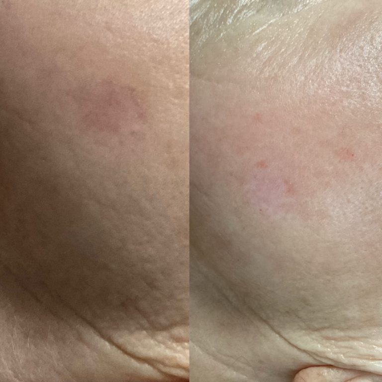 IPL Skin Pigmentation before and after result 15