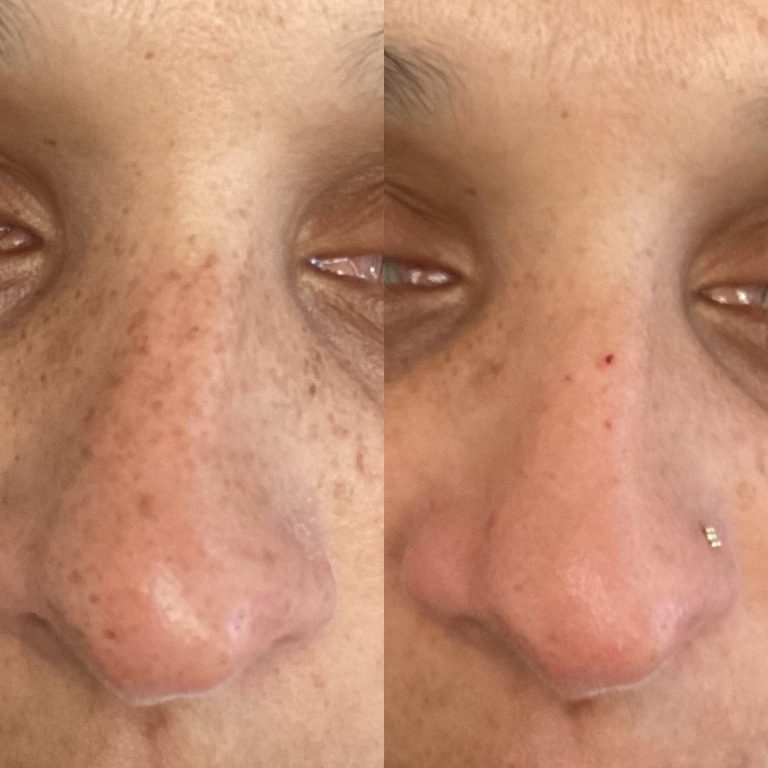 IPL Skin Pigmentation before and after result 16