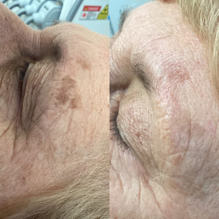 IPL Skin Pigmentation before and after result 17