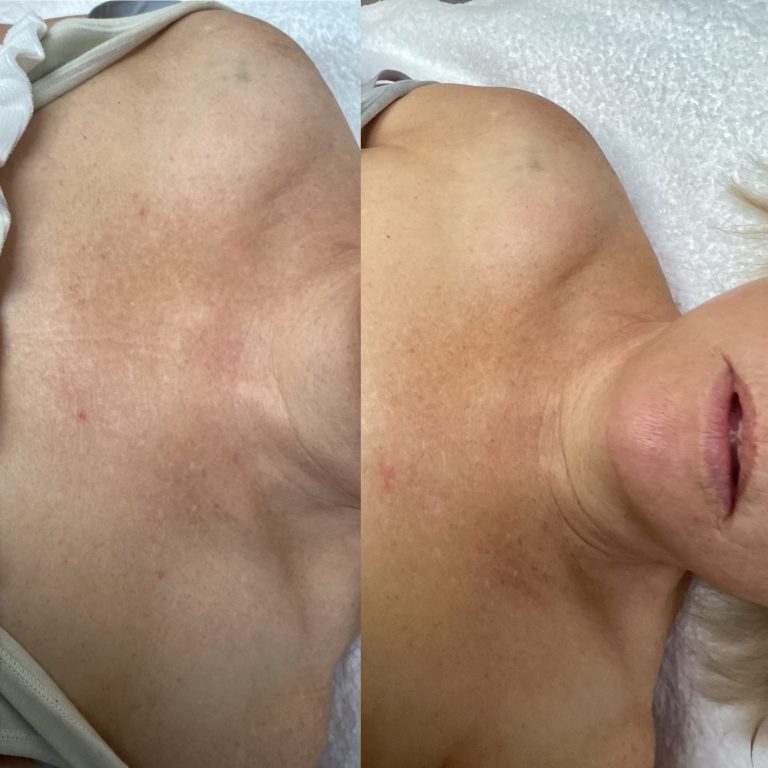 IPL Skin Pigmentation before and after result 18