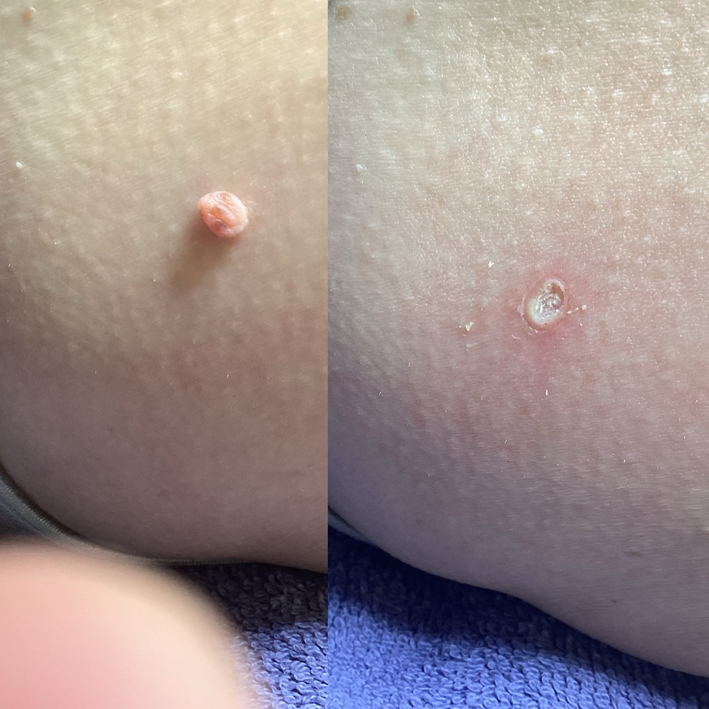 Skin Tags before and after result 1
