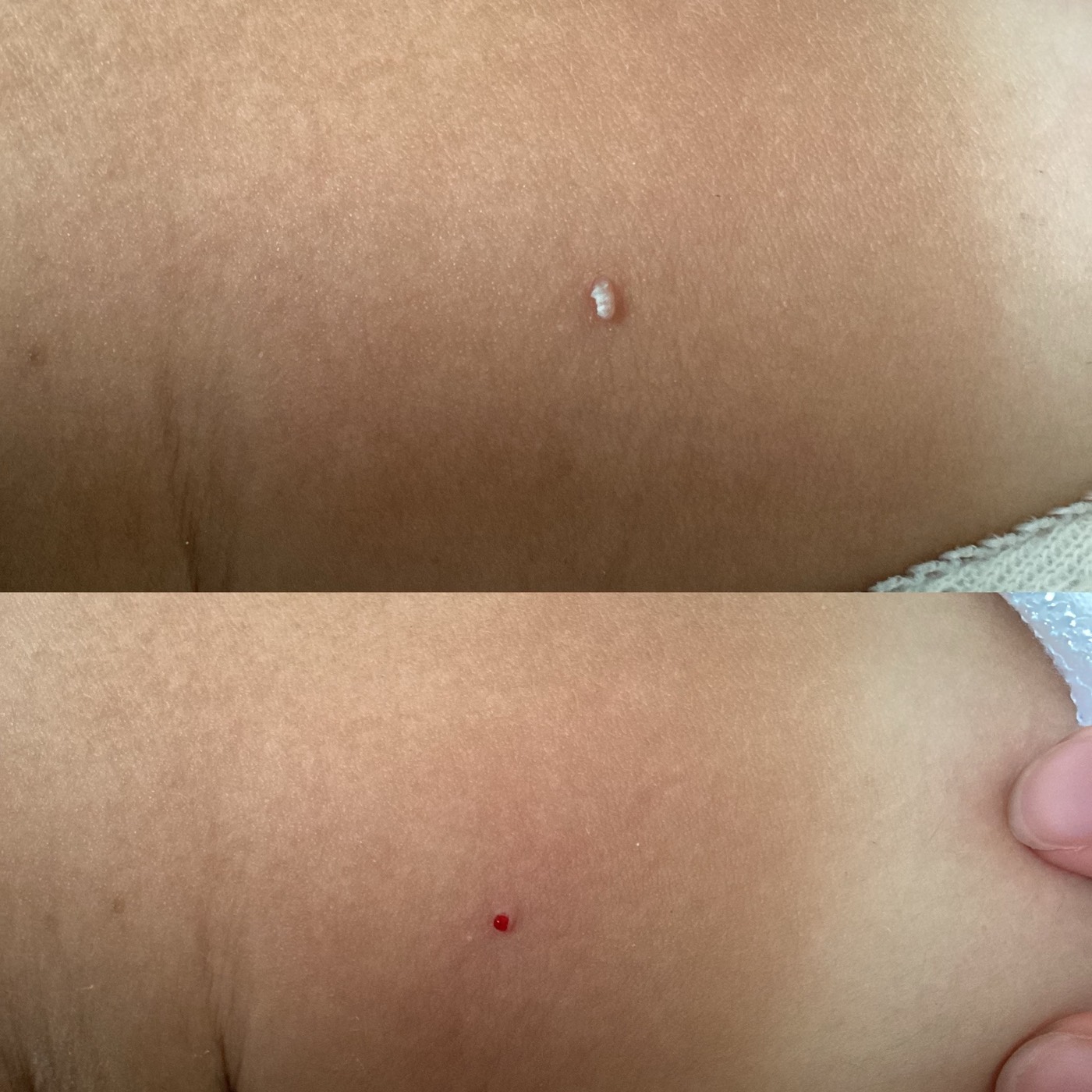 Skin Tags before and after result 2