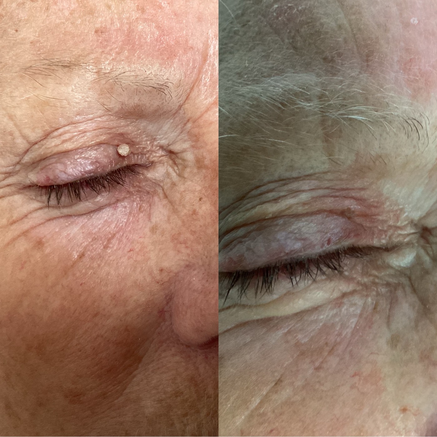 Skin Tags before and after result 3