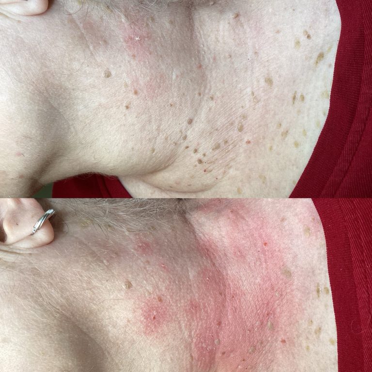 Skin Tags before and after result 4