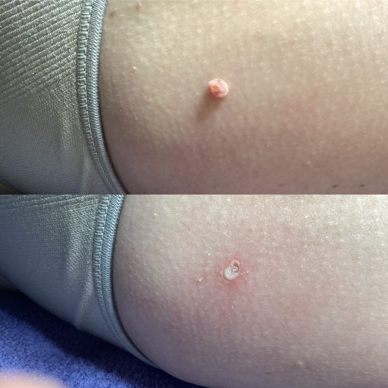 Skin Tags before and after result 5
