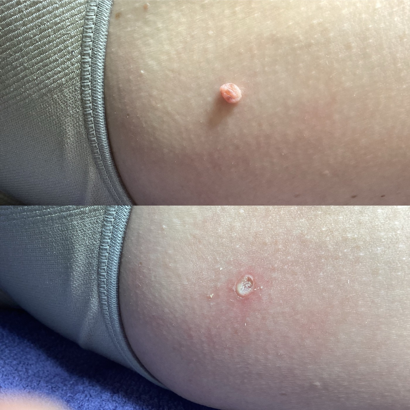 Skin Tags before and after result 5