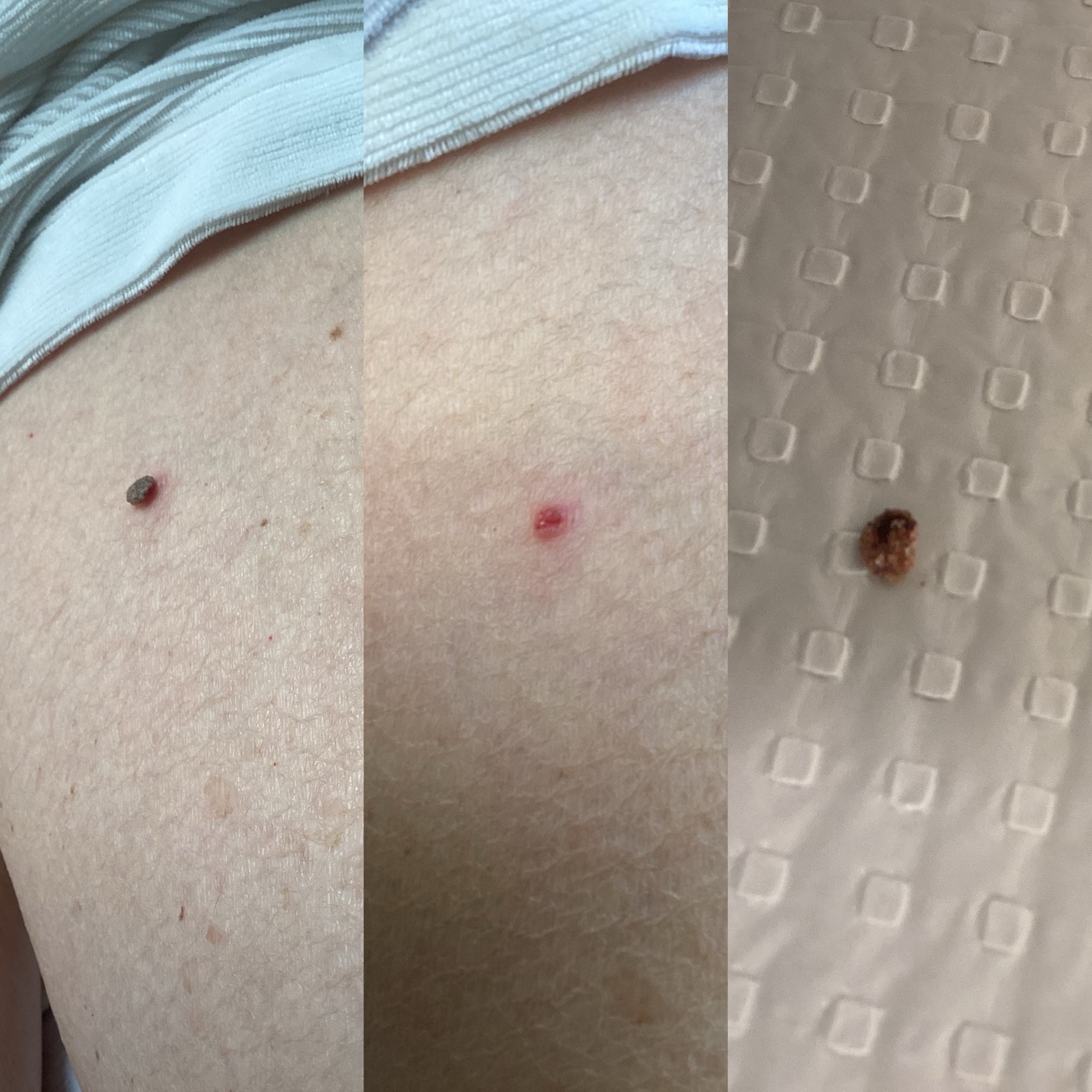 Skin Tags before and after result 6