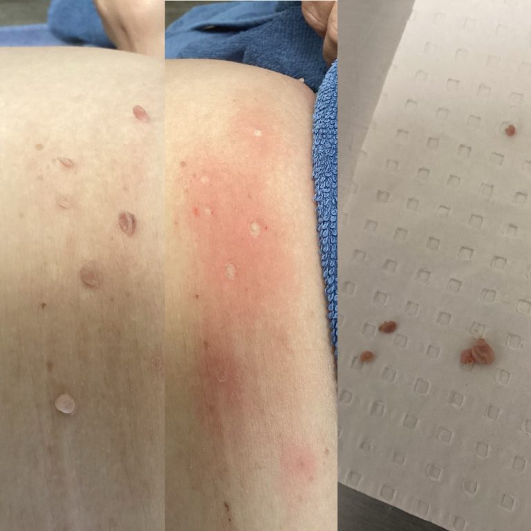 Skin Tags before and after result 7
