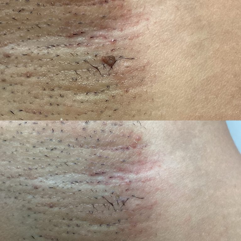 Skin Tags before and after result 8