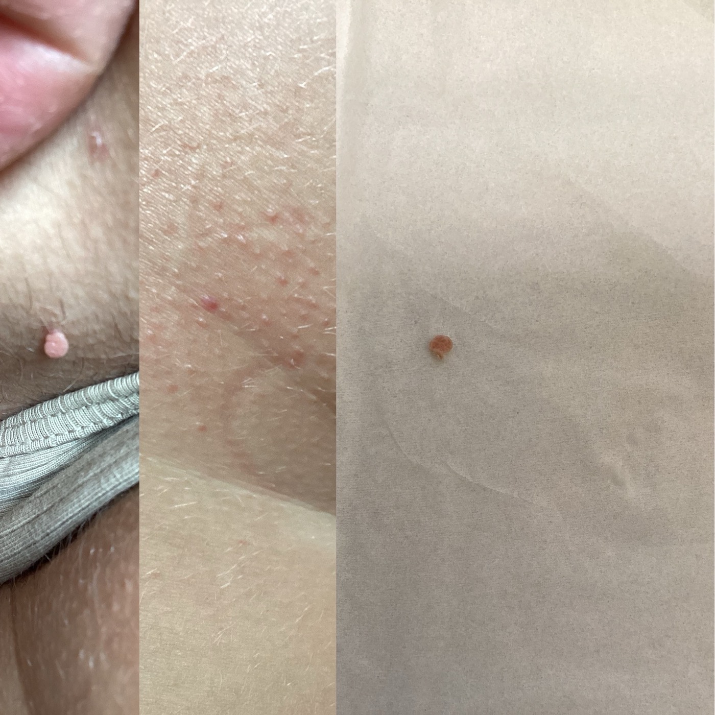 Skin Tags before and after result 10