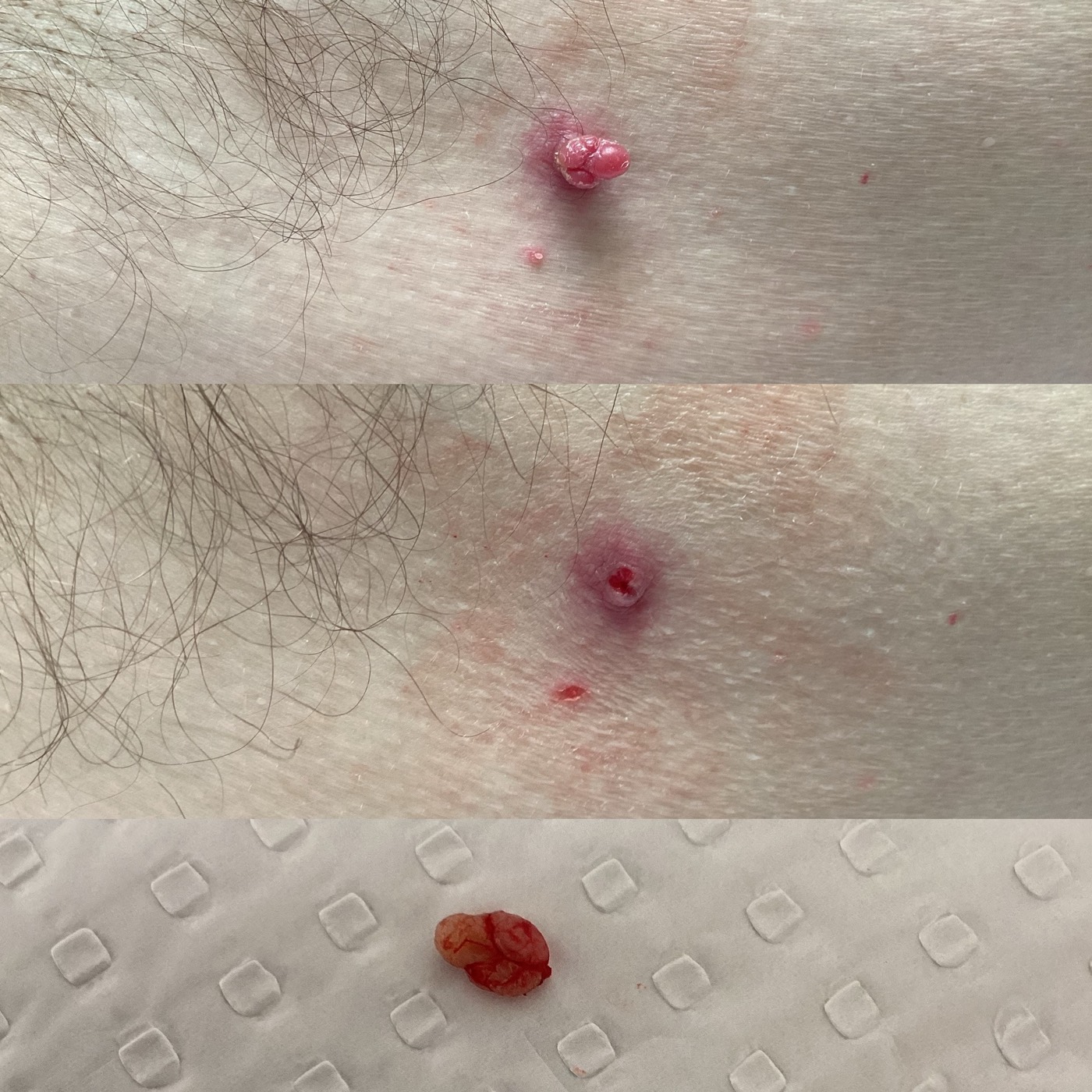 Skin Tags before and after result 12