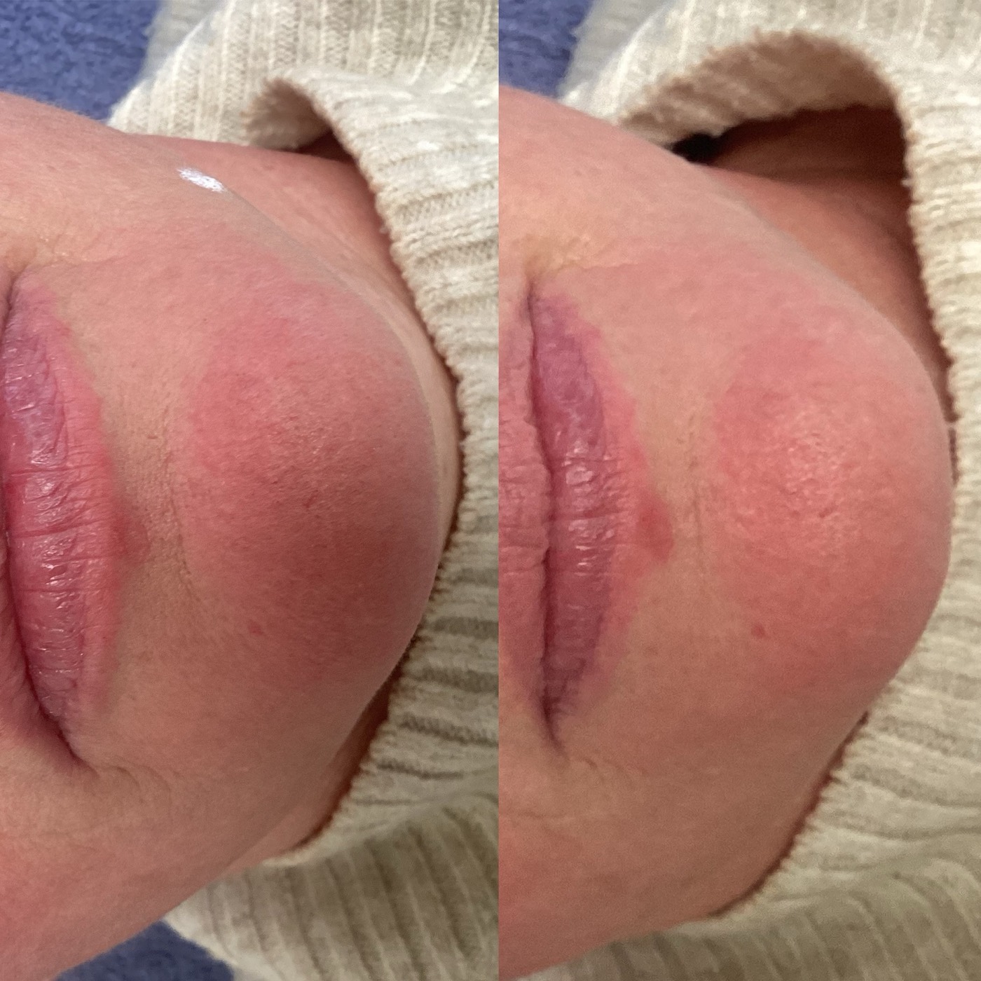 IPL Vascular before and after result 1