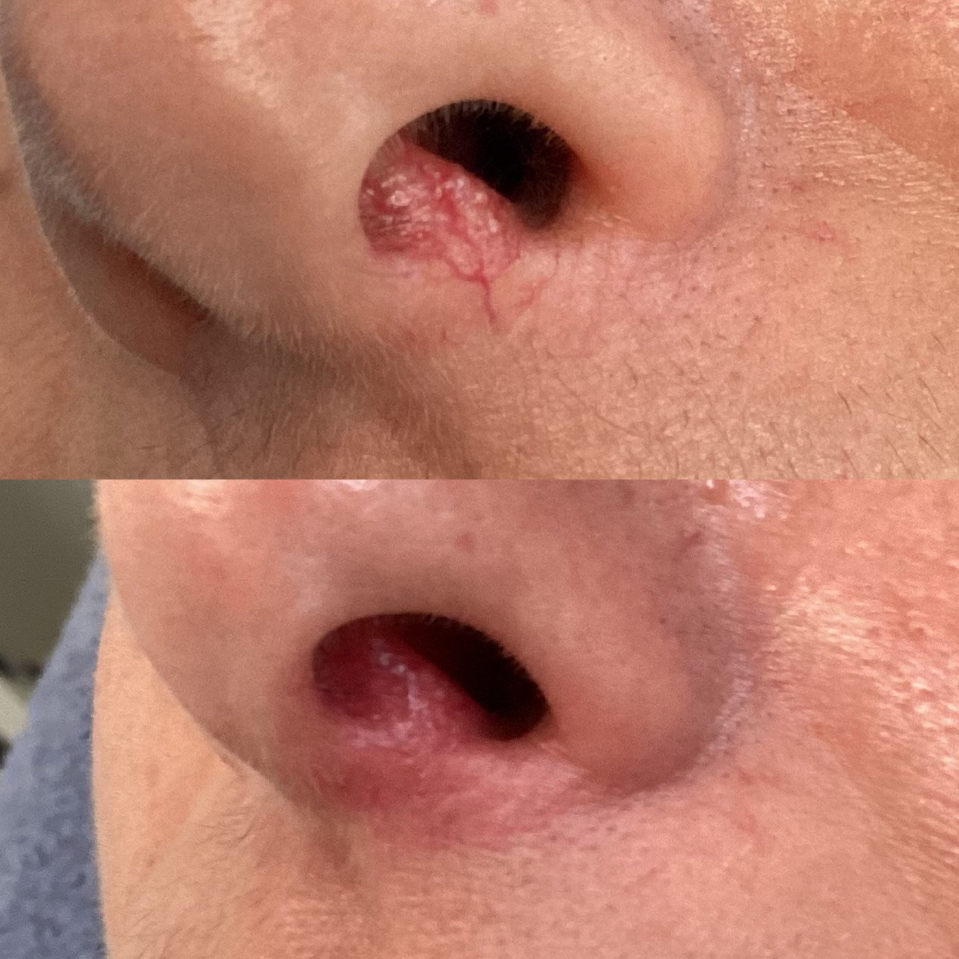 IPL Vascular before and after result 2