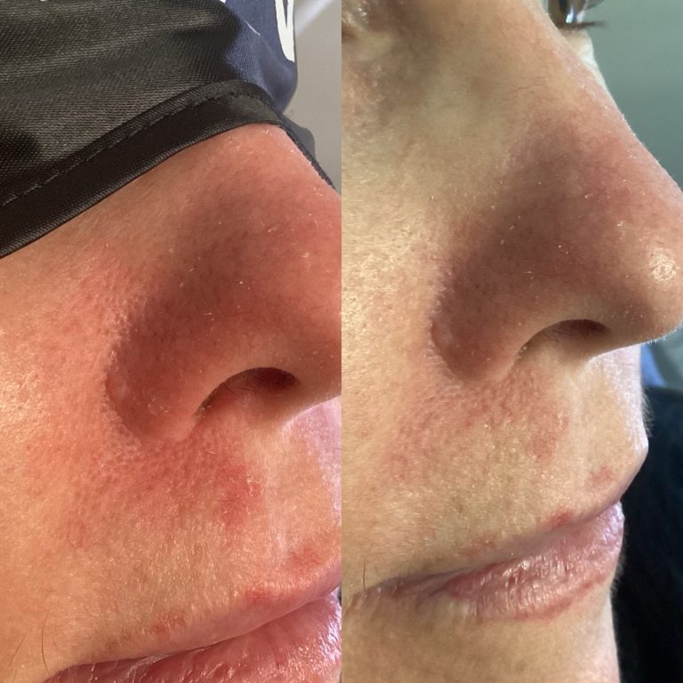 IPL Vascular before and after result 3