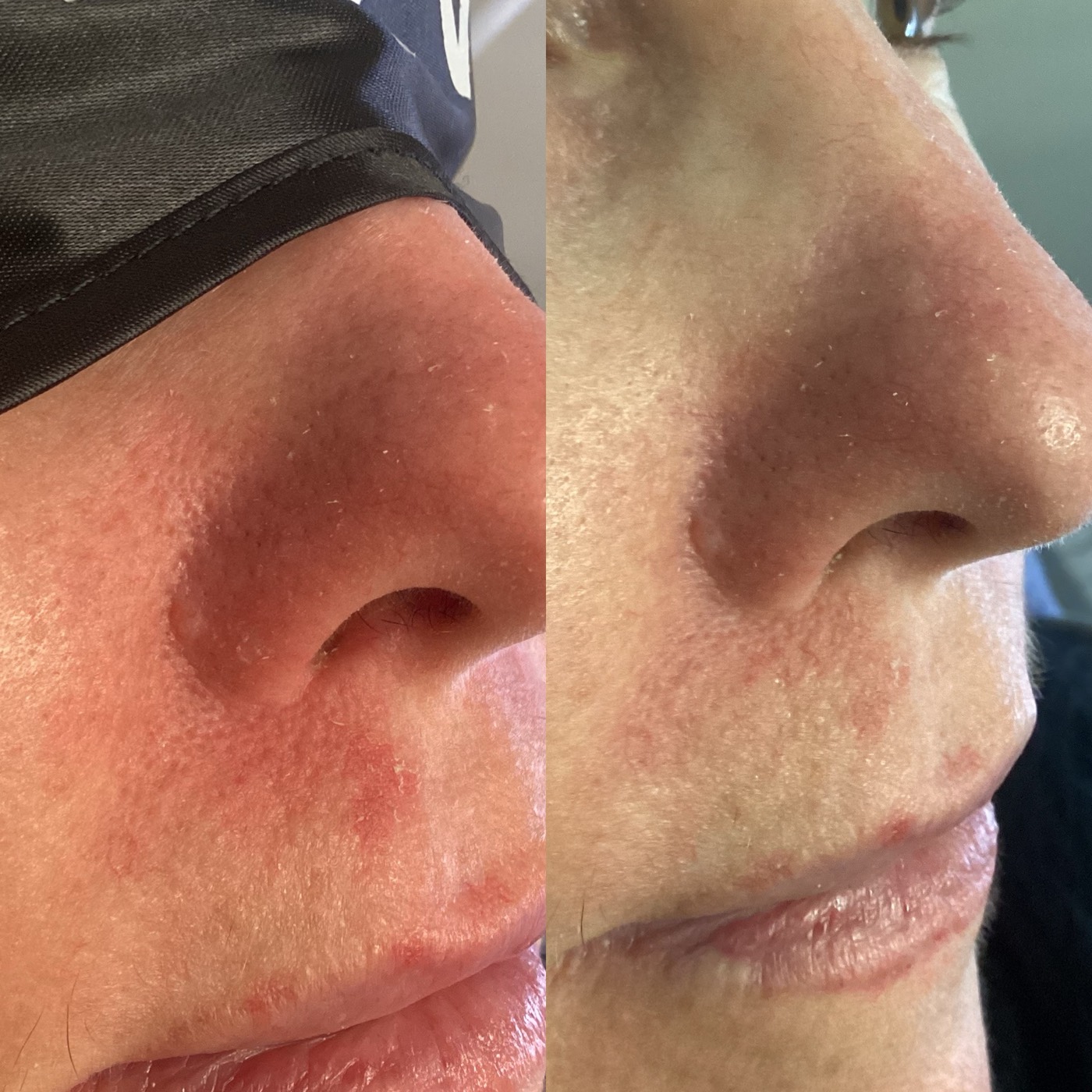 IPL Vascular before and after result 3