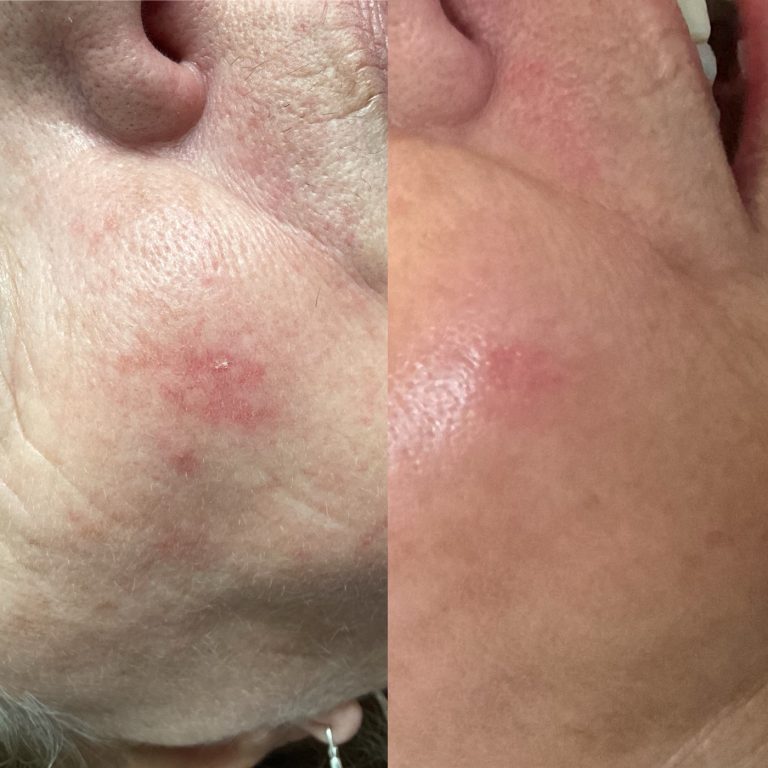 IPL Vascular before and after result 4