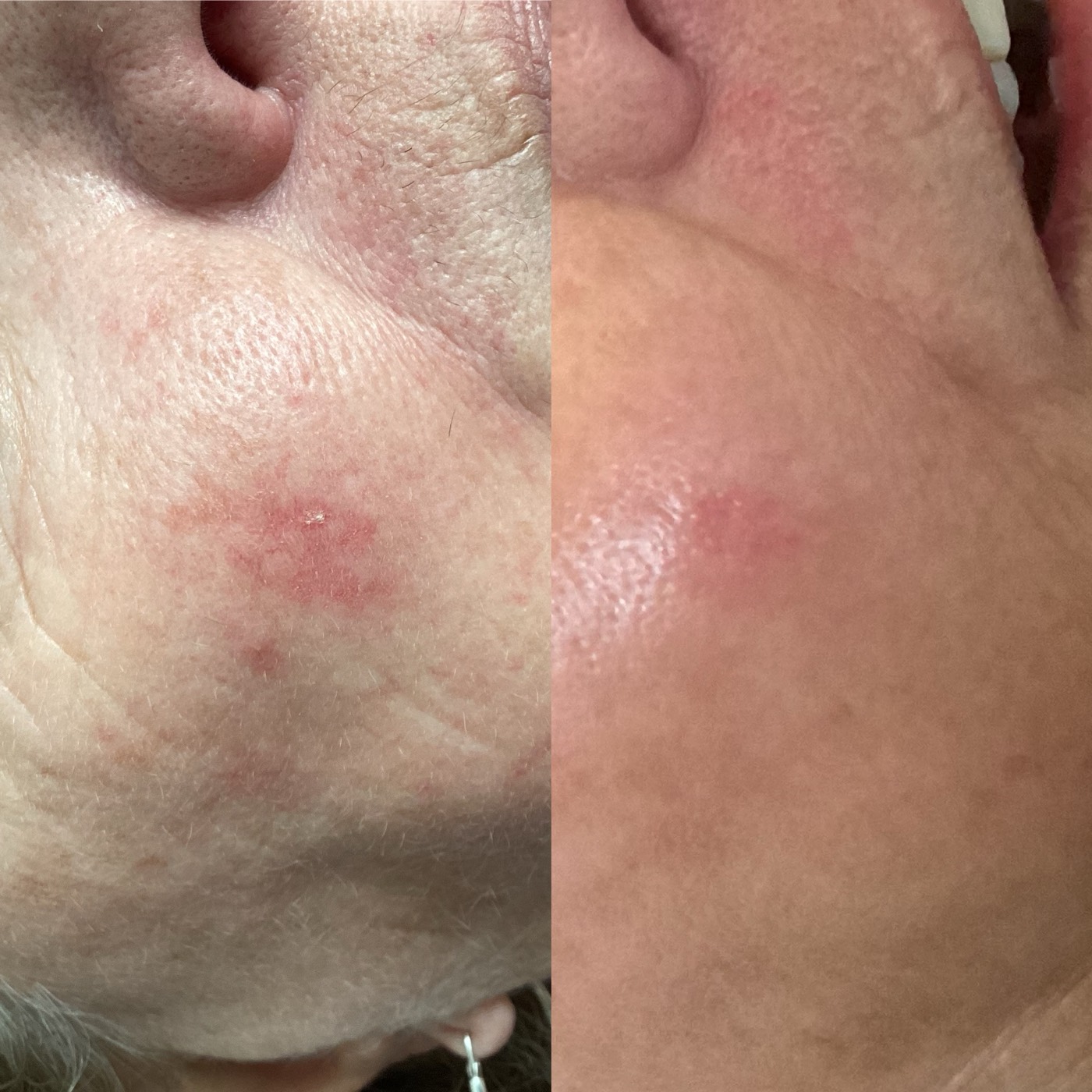 IPL Vascular before and after result 4