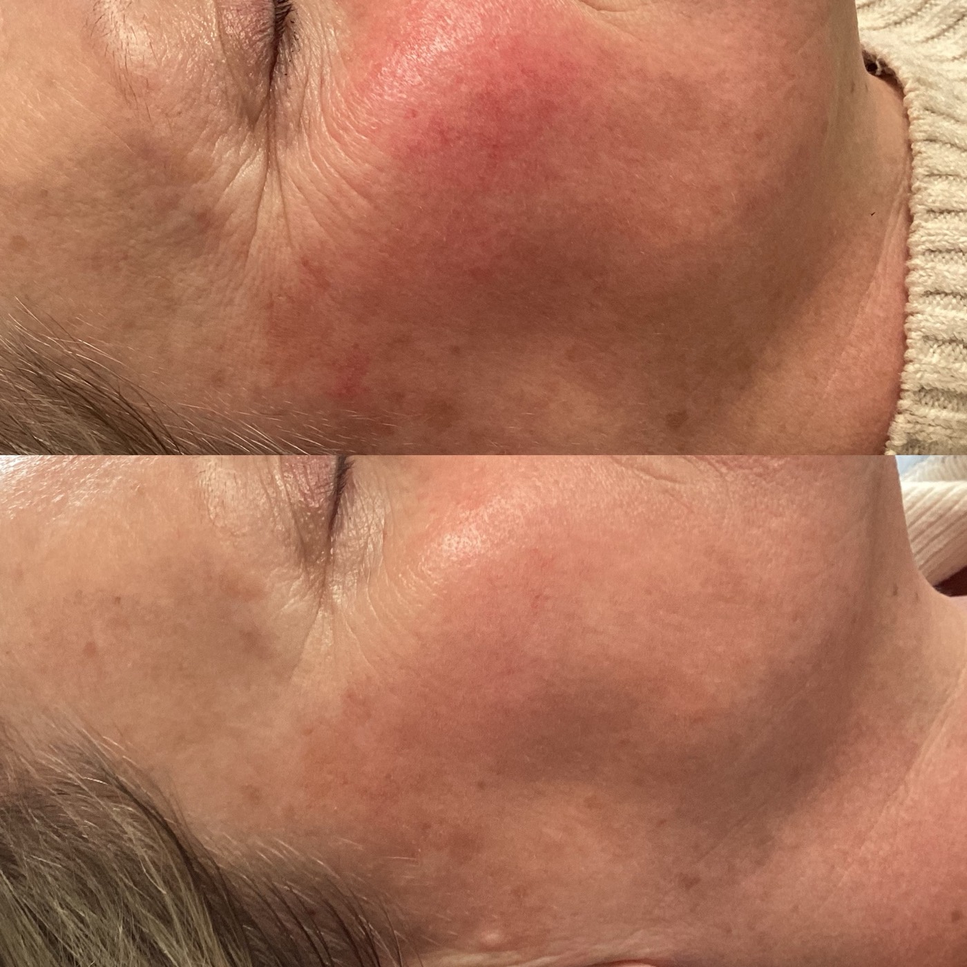 IPL Vascular before and after result 7