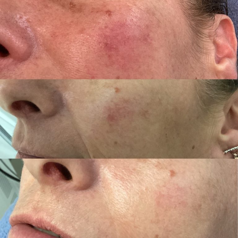 IPL Vascular before and after result 8