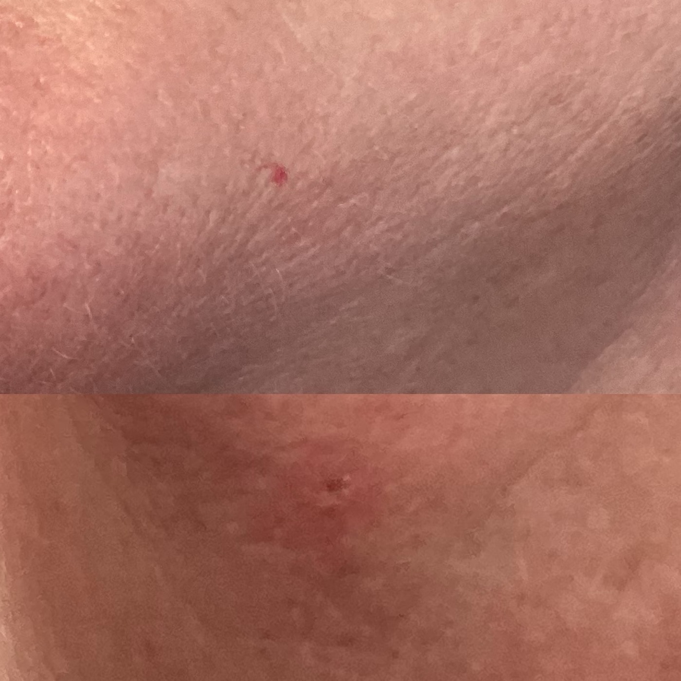 IPL Vascular before and after result 9
