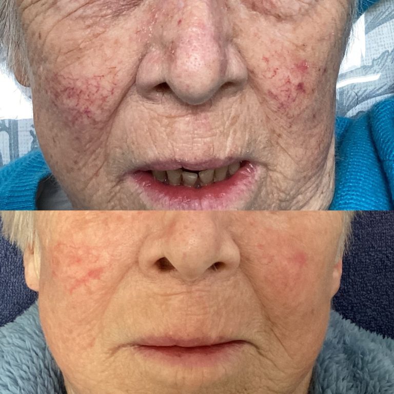 IPL Vascular before and after result 10