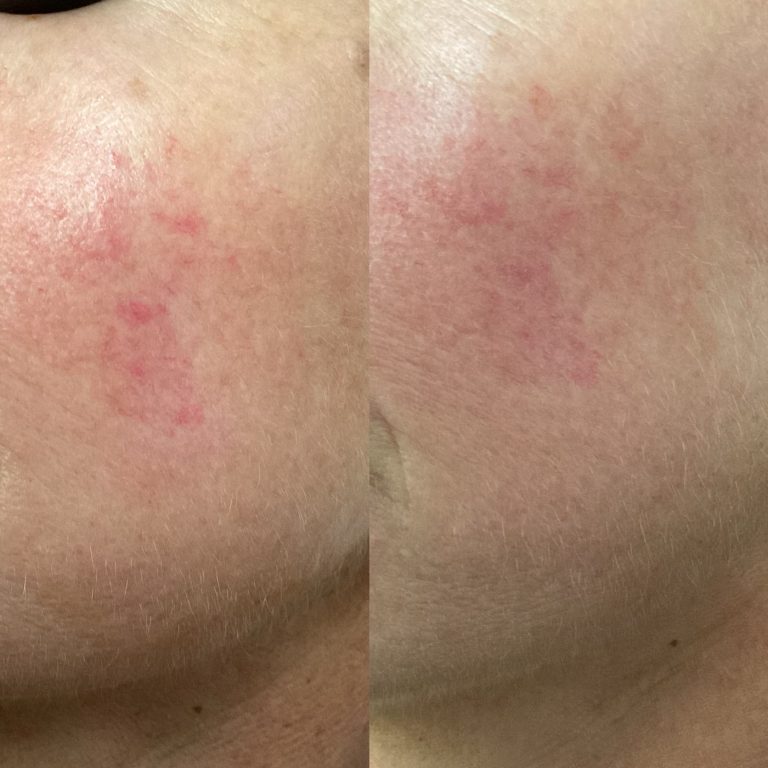 IPL Vascular before and after result 11
