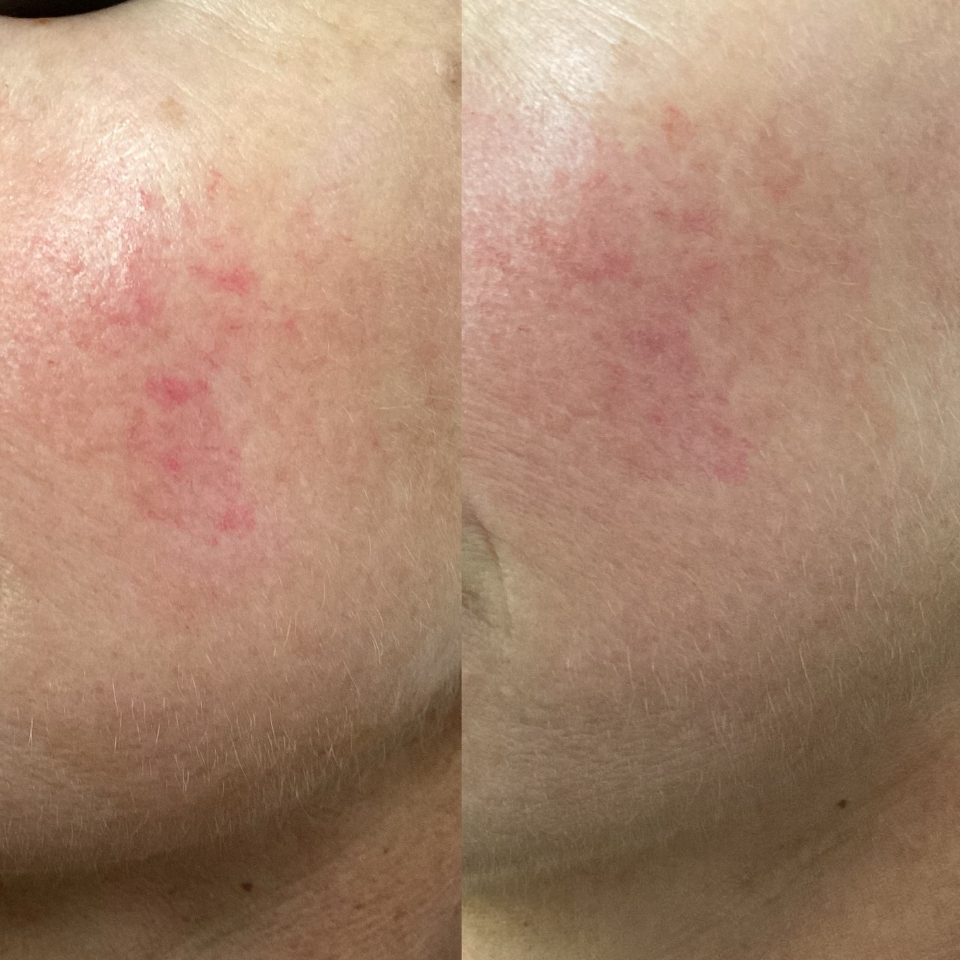 IPL Vascular before and after result 11