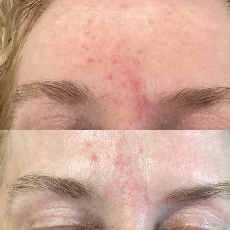 IPL Vascular before and after result 12