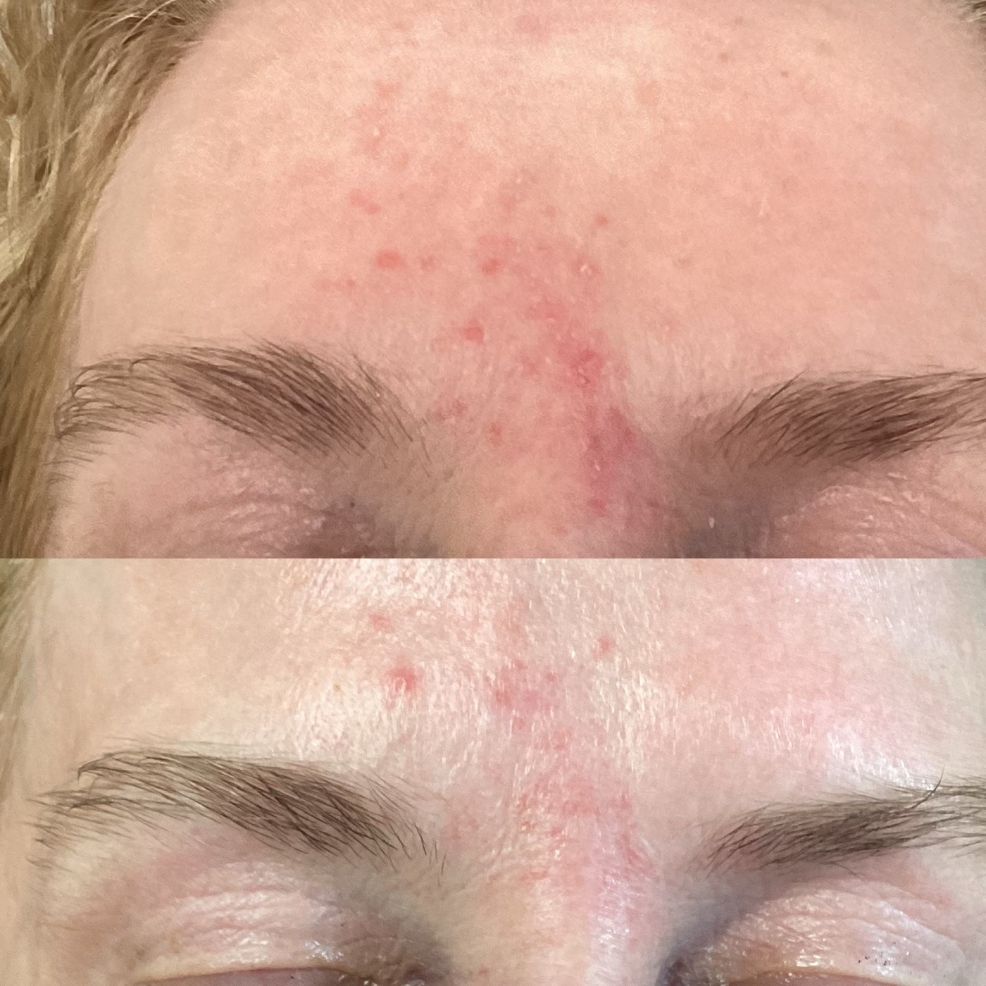 IPL Vascular before and after result 12